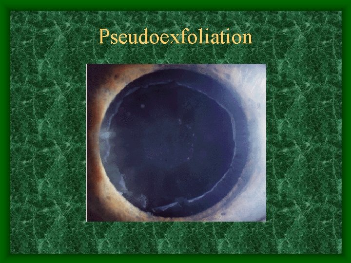 Pseudoexfoliation 