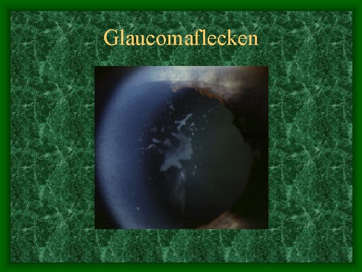 Glaucomaflecken 