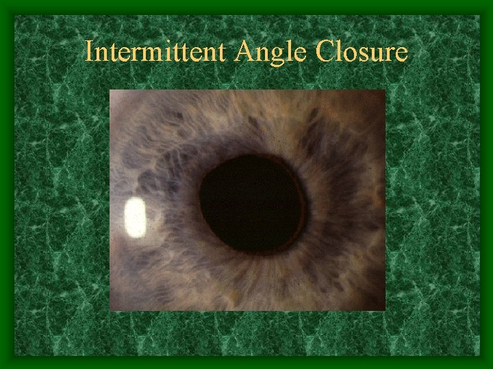 Intermittent Angle Closure 