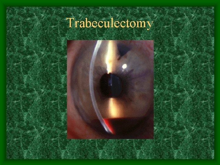 Trabeculectomy 