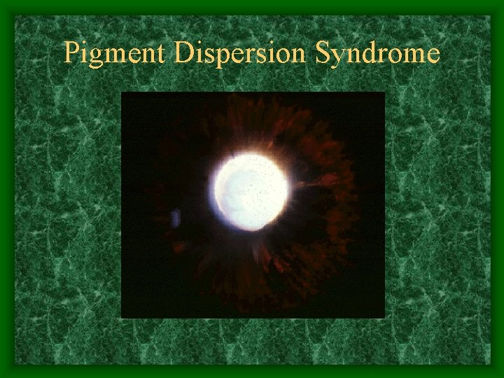 Pigment Dispersion Syndrome 