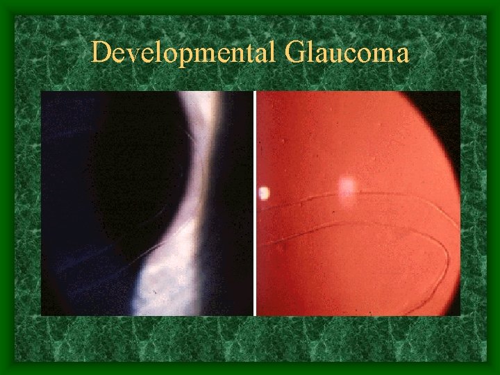 Developmental Glaucoma 