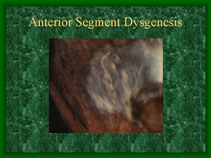 Anterior Segment Dysgenesis 