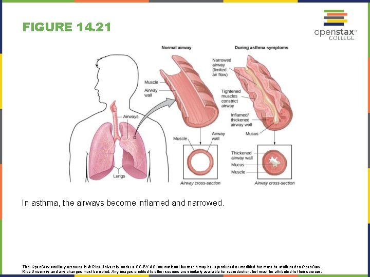 FIGURE 14. 21 In asthma, the airways become inflamed and narrowed. This Open. Stax