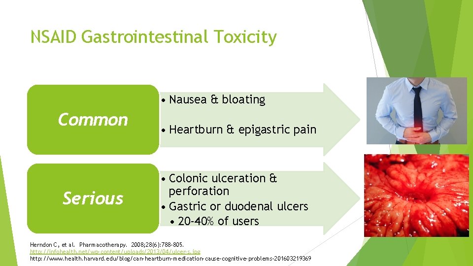 NSAID Gastrointestinal Toxicity • Nausea & bloating Common Serious • Heartburn & epigastric pain