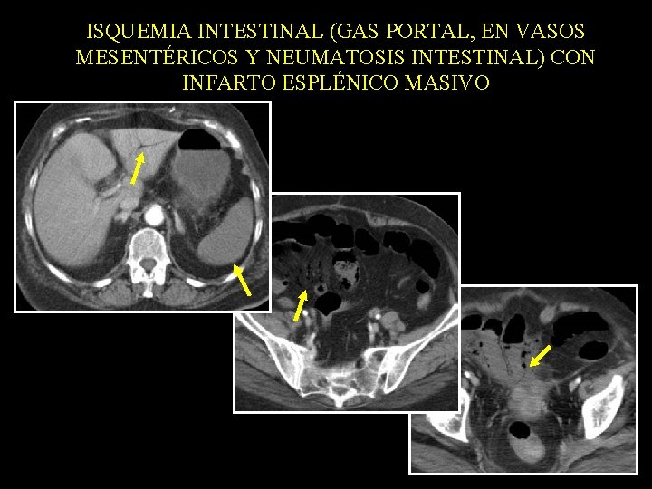 ISQUEMIA INTESTINAL (GAS PORTAL, EN VASOS MESENTÉRICOS Y NEUMATOSIS INTESTINAL) CON INFARTO ESPLÉNICO MASIVO