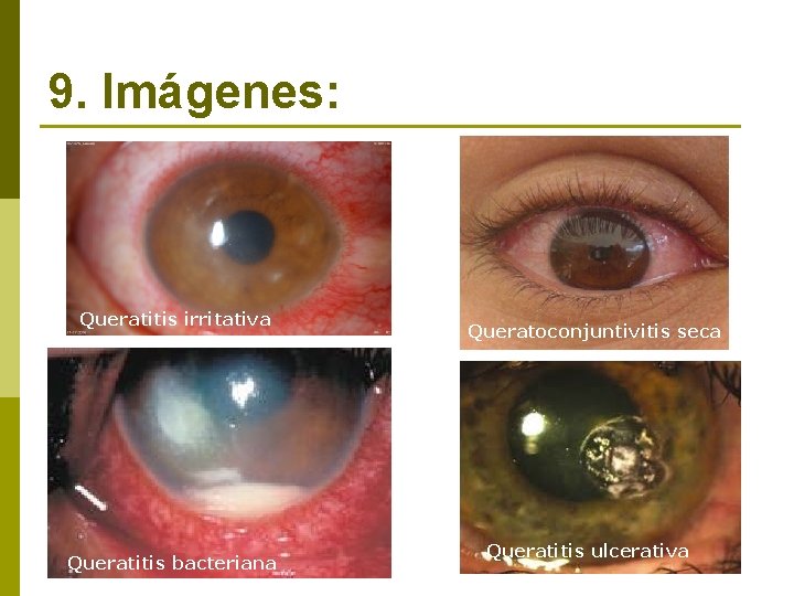 9. Imágenes: Queratitis irritativa Queratitis bacteriana Queratoconjuntivitis seca Queratitis ulcerativa 