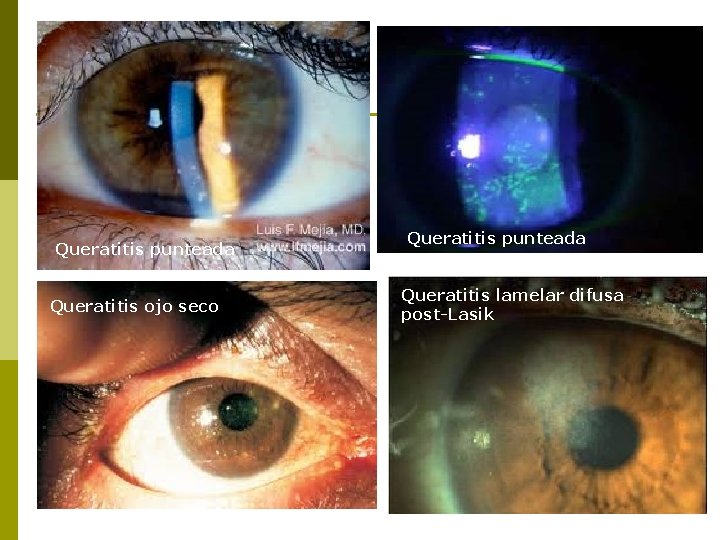 Queratitis punteada Queratitis ojo seco Queratitis punteada Queratitis lamelar difusa post-Lasik 