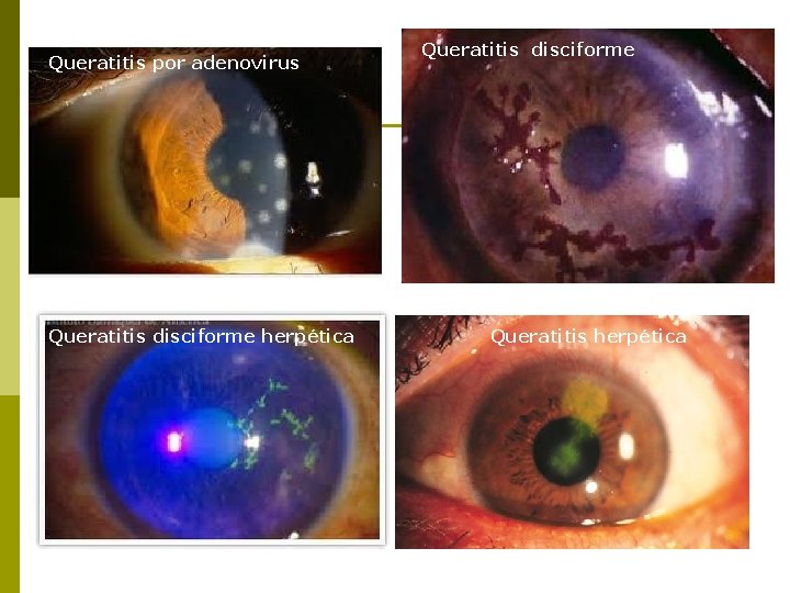 Queratitis por adenovirus Queratitis disciforme herpética Queratitis disciforme Queratitis herpética 