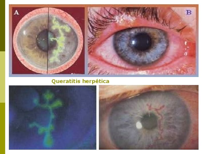 Queratitis herpética 
