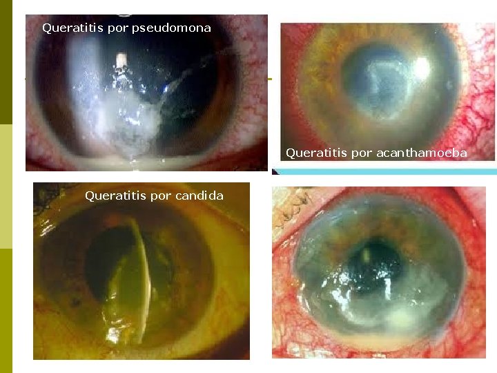 Queratitis por pseudomona Queratitis por acanthamoeba Queratitis por candida 