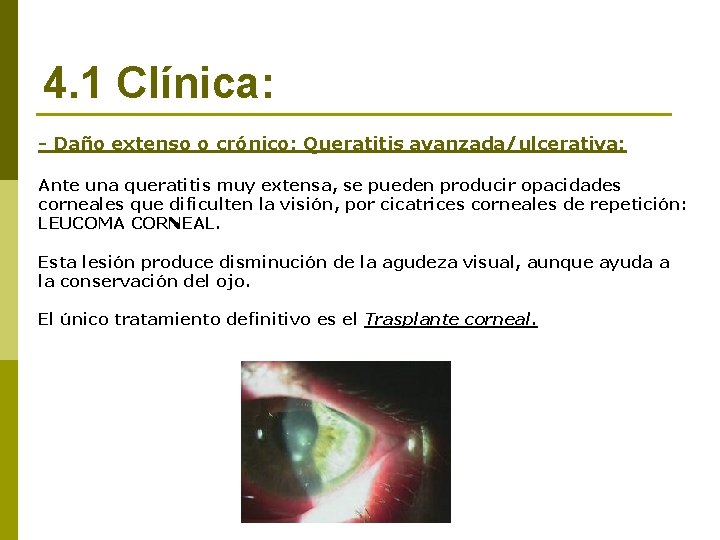 4. 1 Clínica: - Daño extenso o crónico: Queratitis avanzada/ulcerativa: Ante una queratitis muy