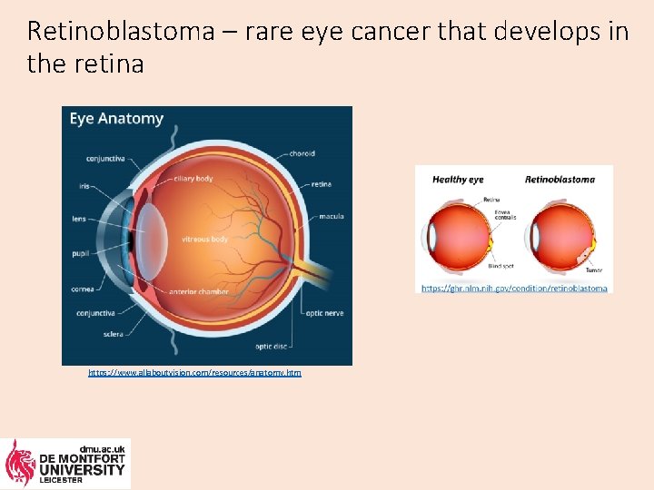Retinoblastoma – rare eye cancer that develops in the retina https: //www. allaboutvision. com/resources/anatomy.