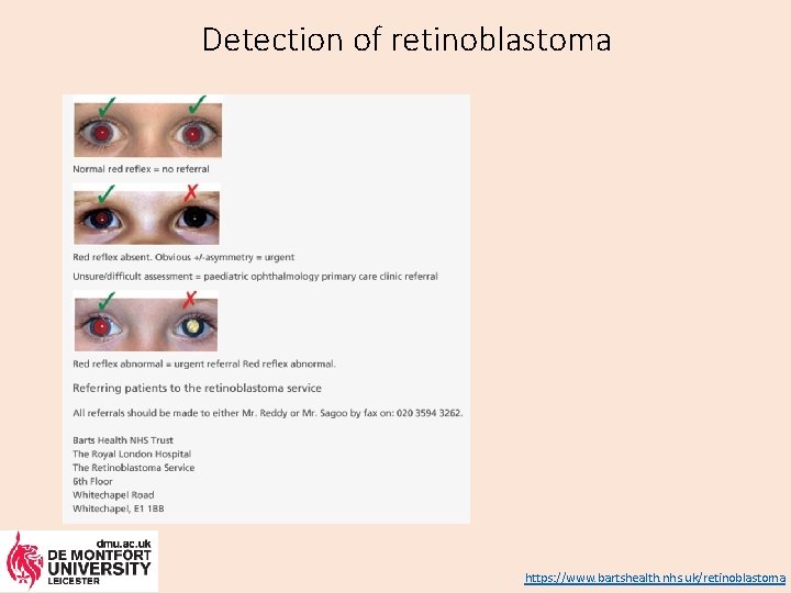 Detection of retinoblastoma https: //www. bartshealth. nhs. uk/retinoblastoma 