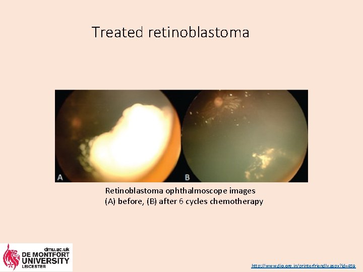 Treated retinoblastoma Retinoblastoma ophthalmoscope images (A) before, (B) after 6 cycles chemotherapy http: //www.