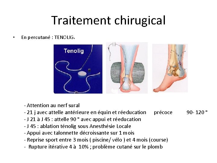Traitement chirugical • En percutané : TENOLIG R - Attention au nerf sural -