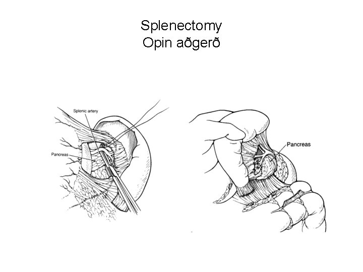 Splenectomy Opin aðgerð 