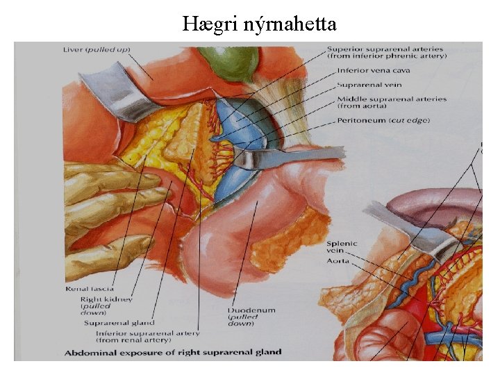 Hægri nýrnahetta 