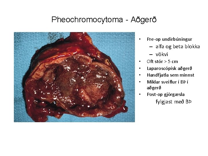 Pheochromocytoma - Aðgerð • Pre-op undirbúningur – alfa og beta blokka – vökvi •