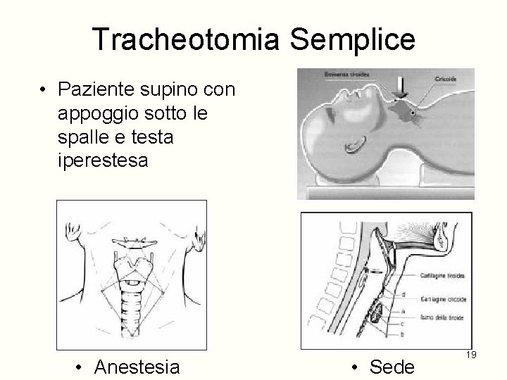 Tracheotomia Semplice • Paziente supino con appoggio sotto le spalle e testa iperestesa •