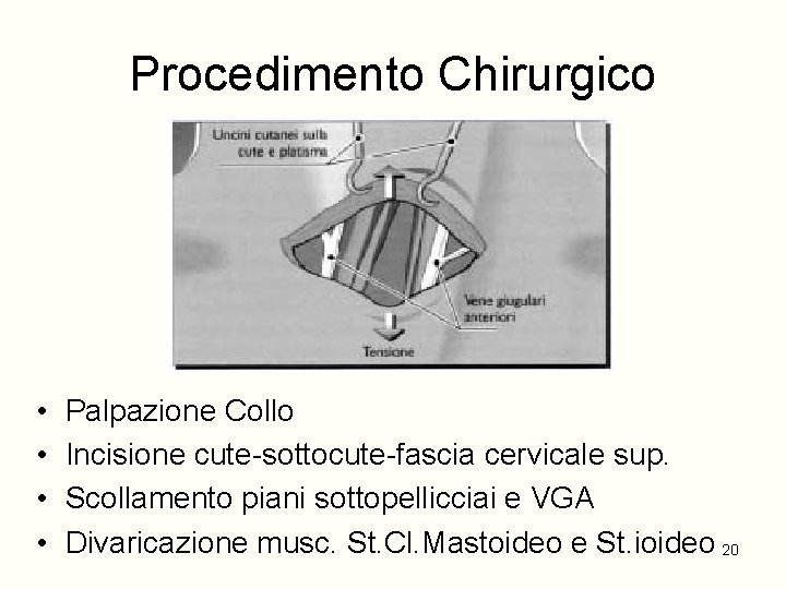 Procedimento Chirurgico • • Palpazione Collo Incisione cute-sottocute-fascia cervicale sup. Scollamento piani sottopellicciai e