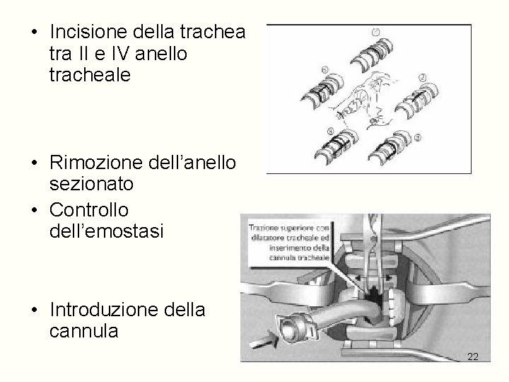  • Incisione della trachea tra II e IV anello tracheale • Rimozione dell’anello