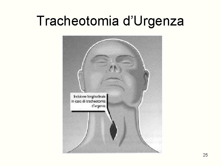 Tracheotomia d’Urgenza 25 