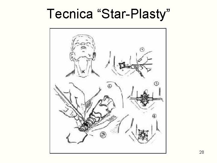 Tecnica “Star-Plasty” 28 