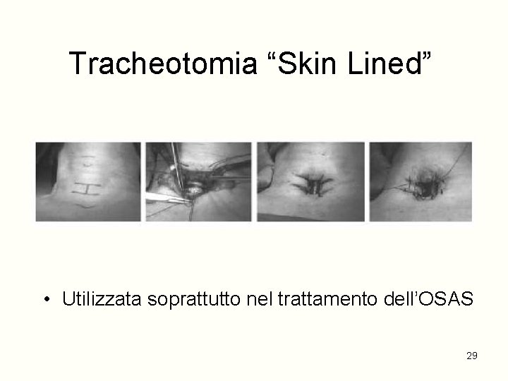 Tracheotomia “Skin Lined” • Utilizzata soprattutto nel trattamento dell’OSAS 29 