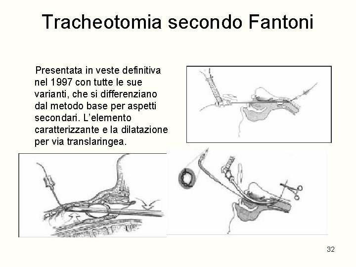 Tracheotomia secondo Fantoni Presentata in veste definitiva nel 1997 con tutte le sue varianti,