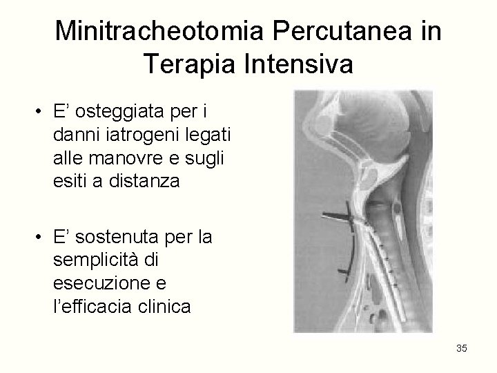 Minitracheotomia Percutanea in Terapia Intensiva • E’ osteggiata per i danni iatrogeni legati alle