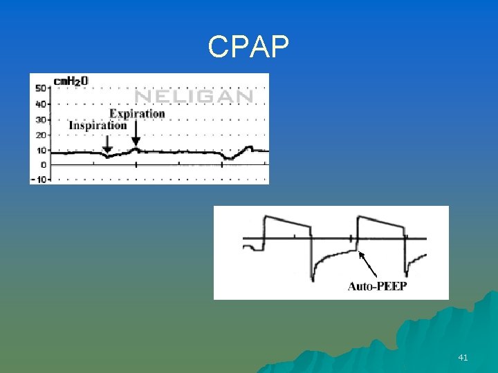 CPAP 41 