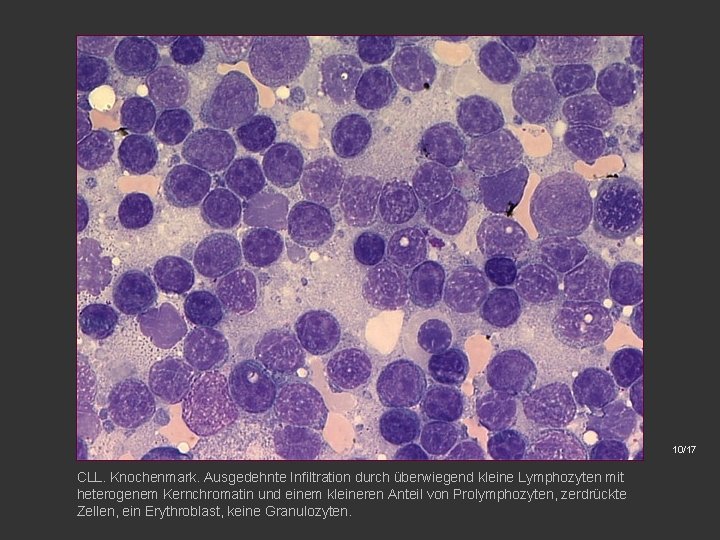 10/17 CLL. Knochenmark. Ausgedehnte Infiltration durch überwiegend kleine Lymphozyten mit heterogenem Kernchromatin und einem