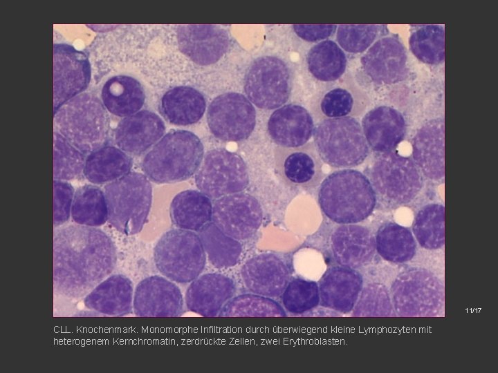 11/17 CLL. Knochenmark. Monomorphe Infiltration durch überwiegend kleine Lymphozyten mit heterogenem Kernchromatin, zerdrückte Zellen,