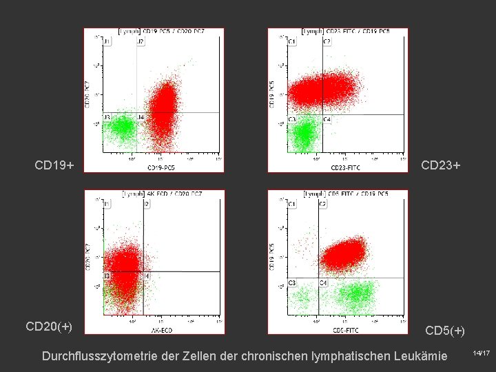 CD 19+ CD 20(+) CD 23+ CD 5(+) Durchflusszytometrie der Zellen der chronischen lymphatischen