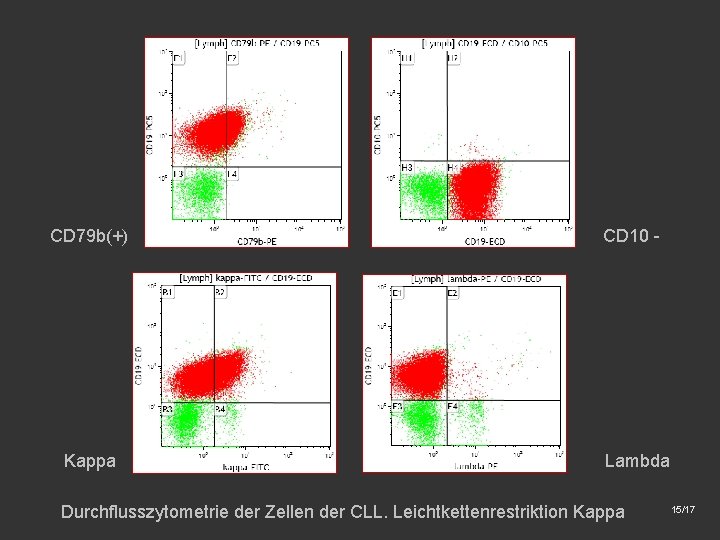 CD 79 b(+) Kappa CD 10 - Lambda Durchflusszytometrie der Zellen der CLL. Leichtkettenrestriktion