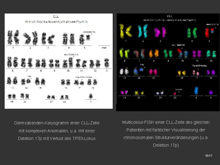 Giemsabanden-Karyogramm einer CLL-Zelle Multicolour-FISH einer CLL-Zelle des gleichen mit komplexen Anomalien, u. a. mit