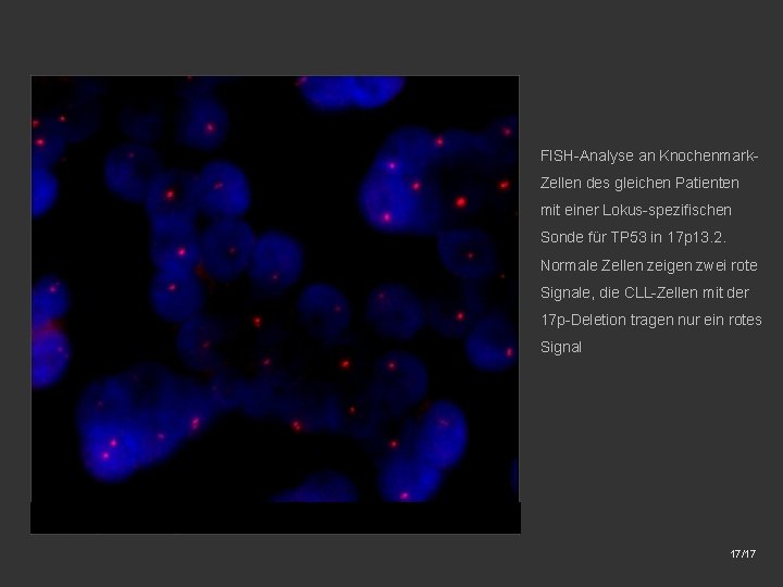 FISH-Analyse an Knochenmark. Zellen des gleichen Patienten mit einer Lokus-spezifischen Sonde für TP 53