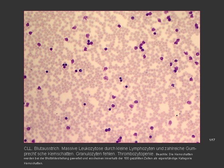 1/17 CLL. Blutausstrich. Massive Leukozytose durch kleine Lymphozyten und zahlreiche Gumprecht`sche Kernschatten. Granulozyten fehlen.