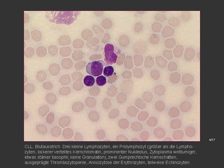 4/17 CLL. Blutausstrich. Drei kleine Lymphozyten, ein Prolymphozyt (größer als die Lymphozyten, lockerer verteiltes