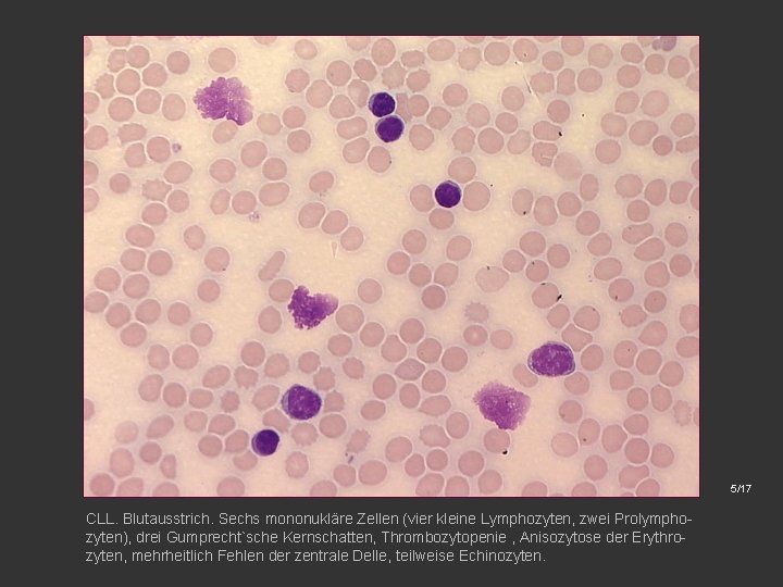 5/17 CLL. Blutausstrich. Sechs mononukläre Zellen (vier kleine Lymphozyten, zwei Prolymphozyten), drei Gumprecht`sche Kernschatten,