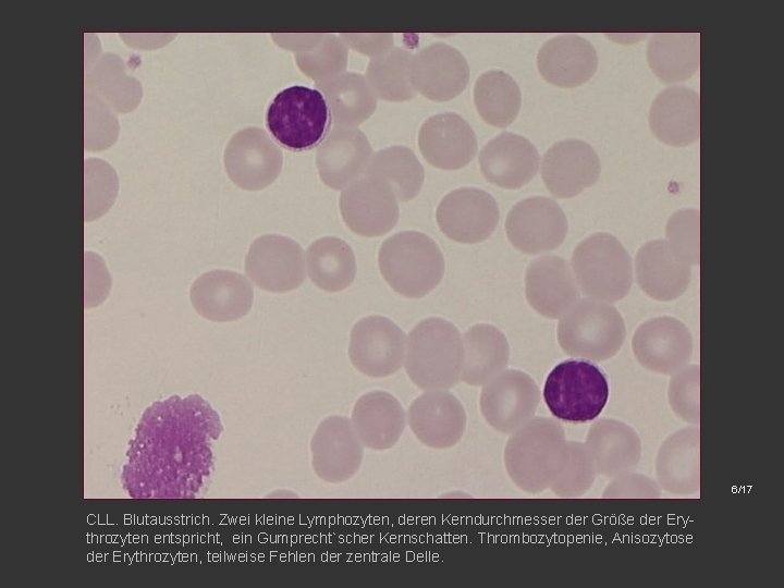 6/17 CLL. Blutausstrich. Zwei kleine Lymphozyten, deren Kerndurchmesser der Größe der Erythrozyten entspricht, ein