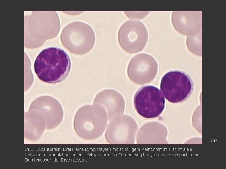 7/17 CLL. Blutausstrich. Drei kleine Lymphozyten mit scholligem Kernchromatin, schmalem, hellbauem, granulationsfreiem Zytoplasma. Größe