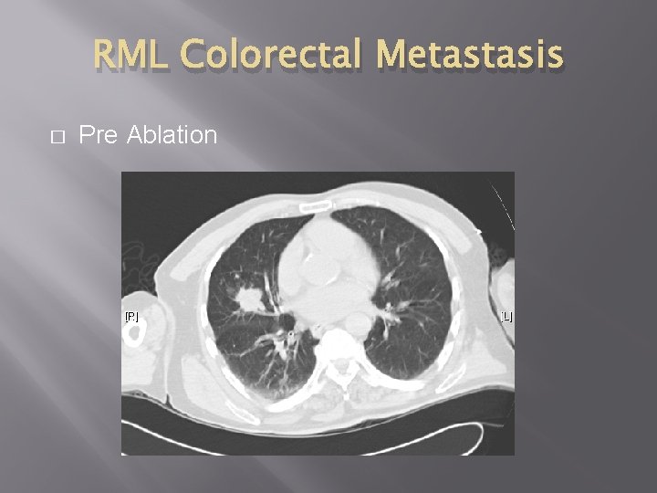 RML Colorectal Metastasis � Pre Ablation 