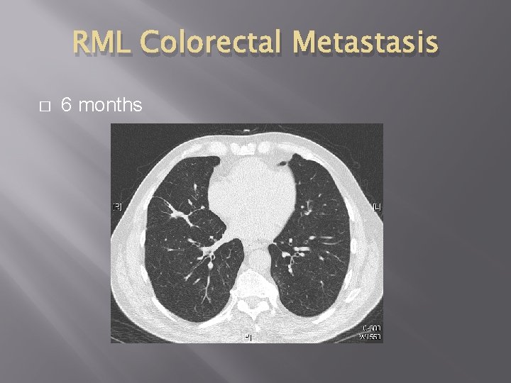 RML Colorectal Metastasis � 6 months 