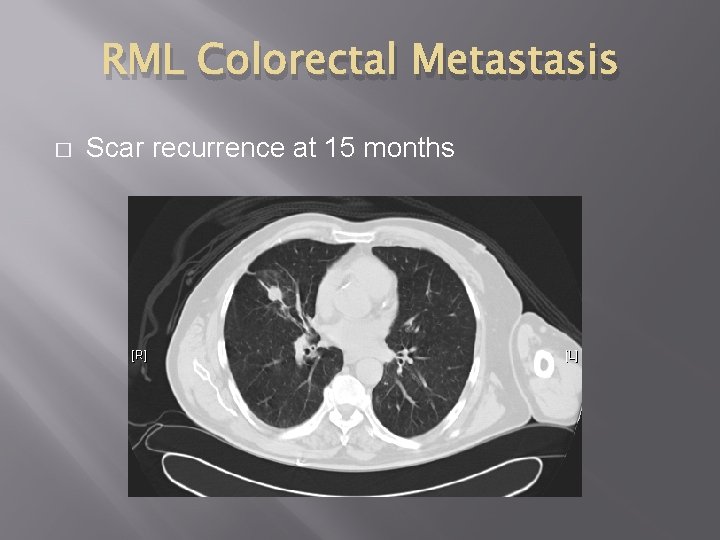 RML Colorectal Metastasis � Scar recurrence at 15 months 