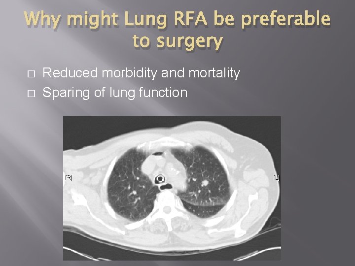 Why might Lung RFA be preferable to surgery � � Reduced morbidity and mortality