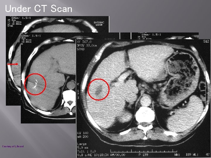 Under CT Scan Courtesy of L. Berard 
