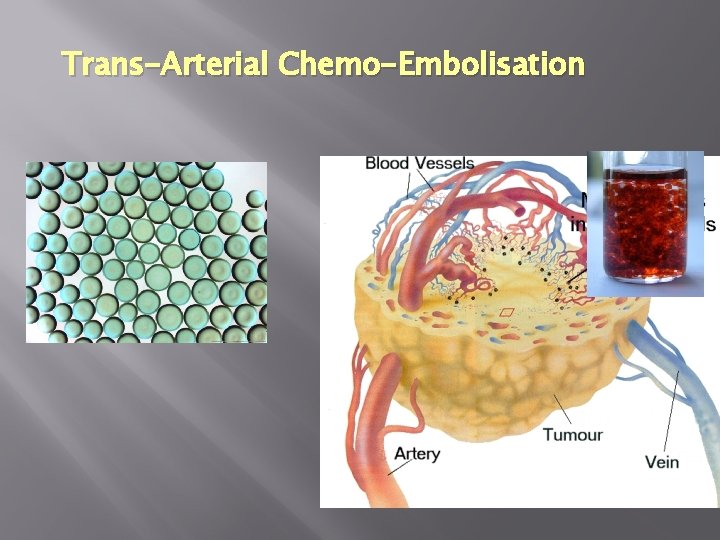 Trans-Arterial Chemo-Embolisation 