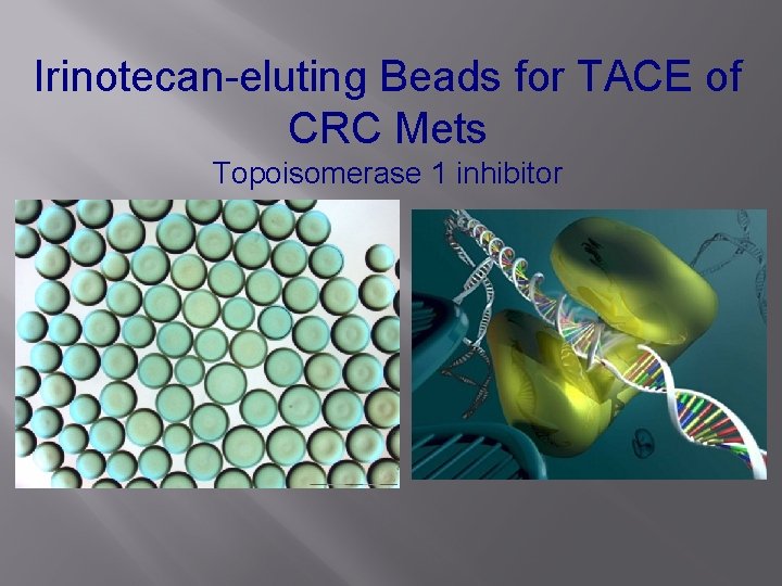 Irinotecan-eluting Beads for TACE of CRC Mets Topoisomerase 1 inhibitor 